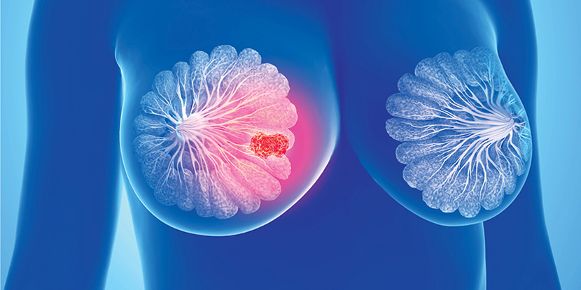 2nd Annual Breast Cancer Symposium